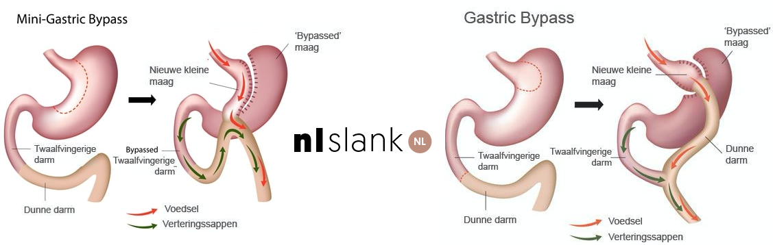 Maagverkleining Voor En Nadelen Voor De Gezondheid En Afvallen